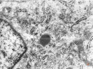 F, 61y. | malignant hemangioendothelioma of thyroid F, 61y. | malignant hemangioendothelioma of thyroid